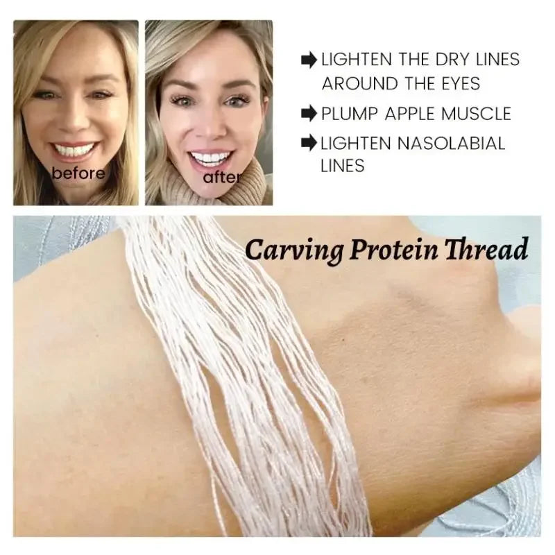 Silk Fibroin Thread Lift